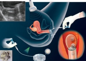 embryo-transfer-with-ivf